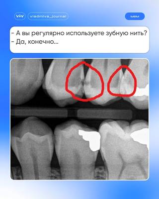 Контактный кариес: незаметный враг, стремительное разрушение.